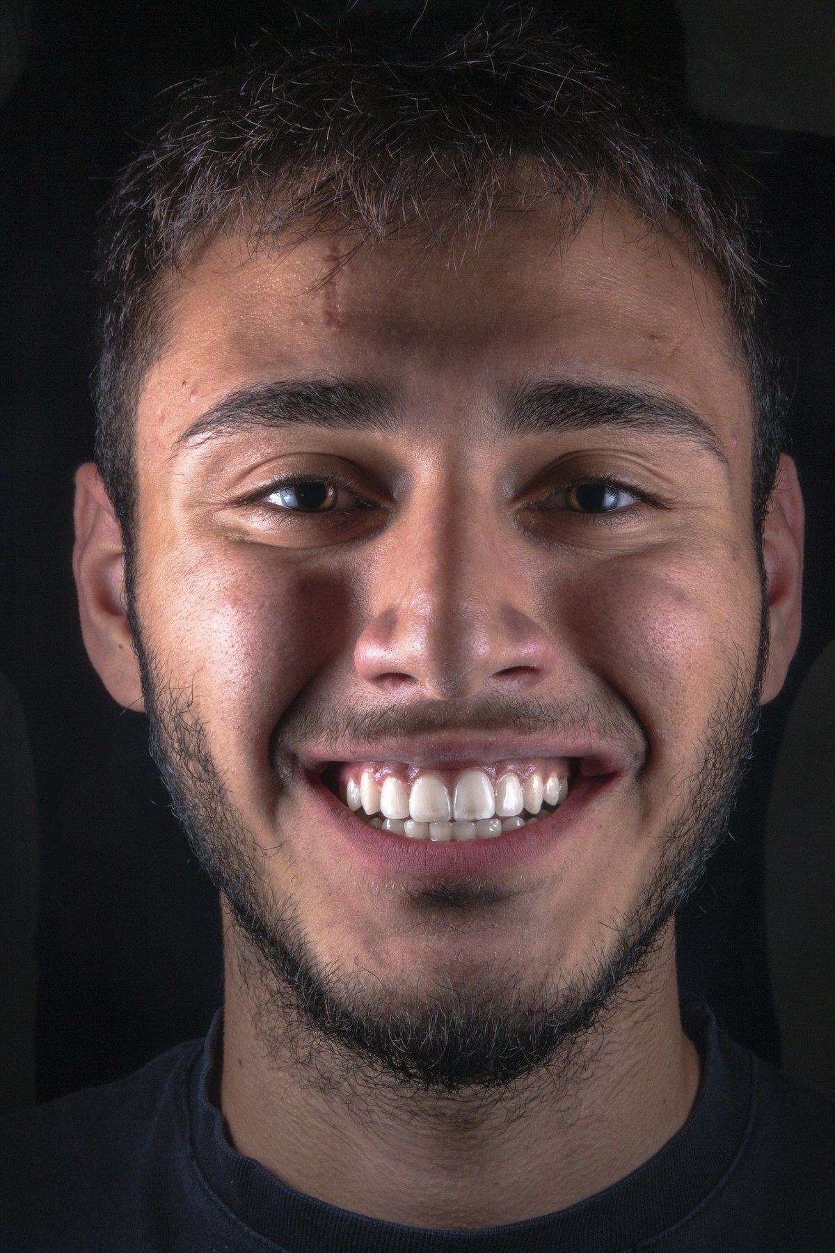 Stunning smile transformation with veneers